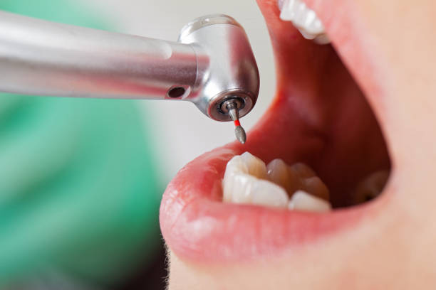 Best Emergency Tooth Extraction in Coto De Za, CA